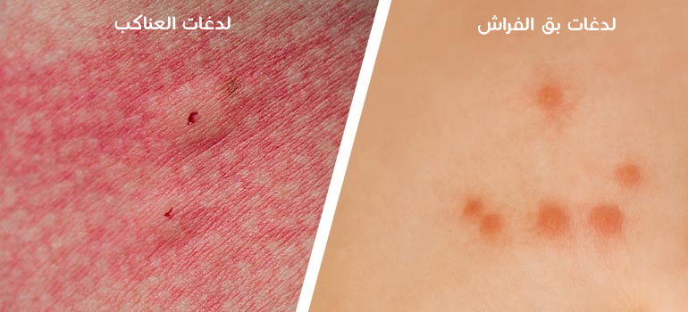 لدغات  العناكب و بق الفراش