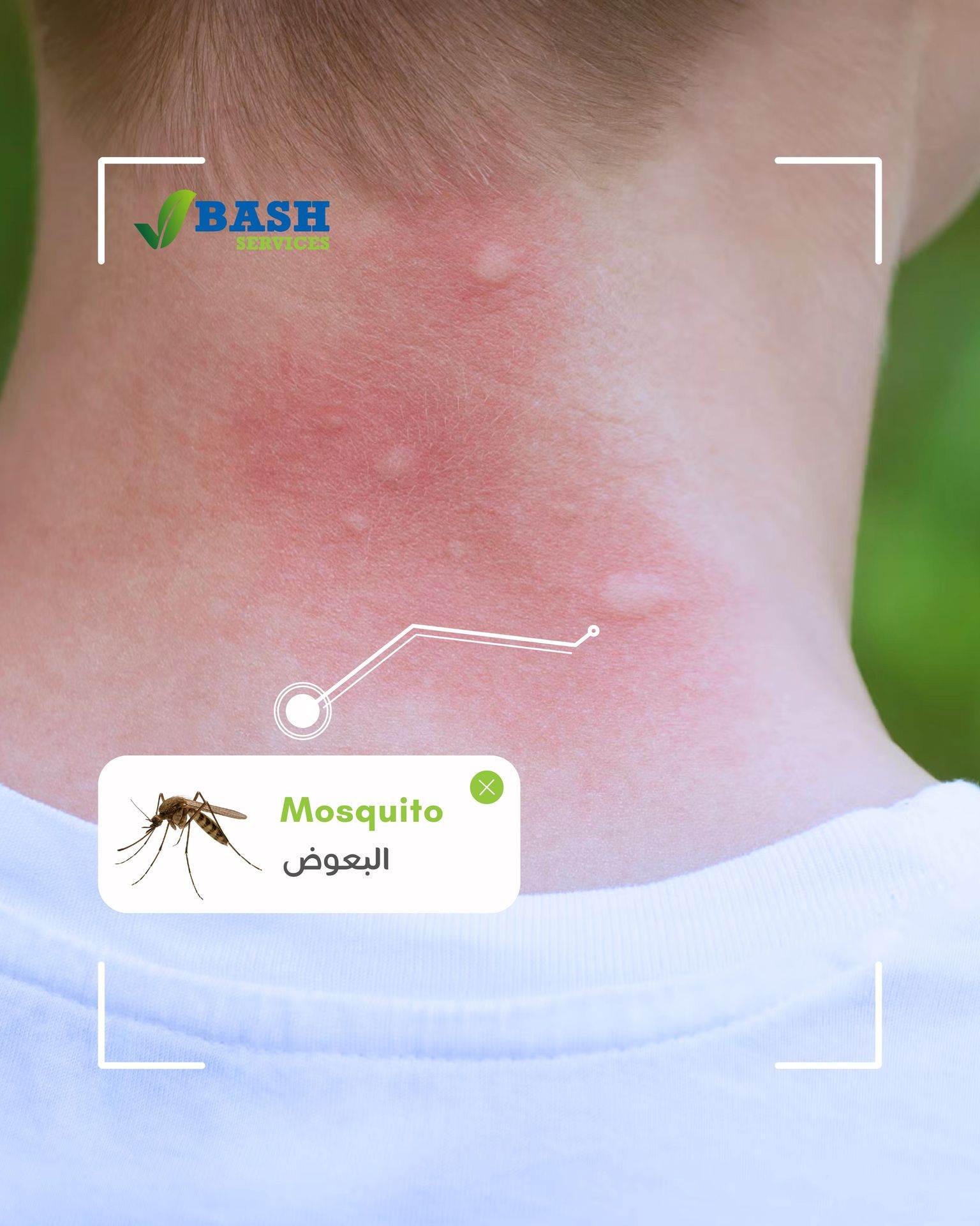 قرصات و لدغات البعوض